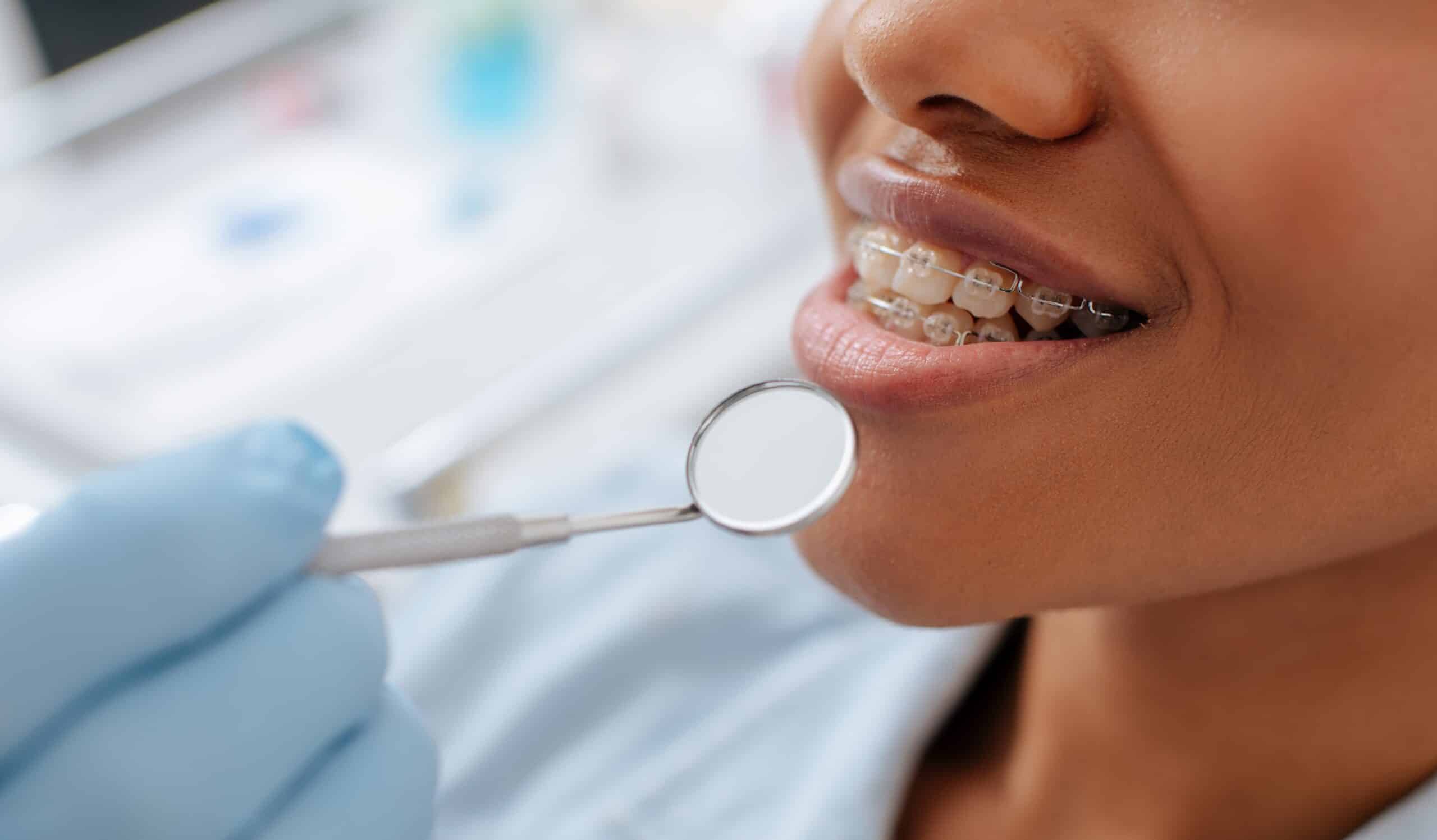 Orthodontie : prendre soin de son appareil dentaire